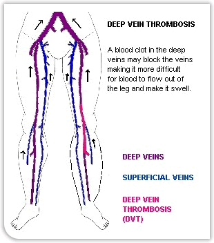 Anatomy Chart Deep Vein Thrombosis